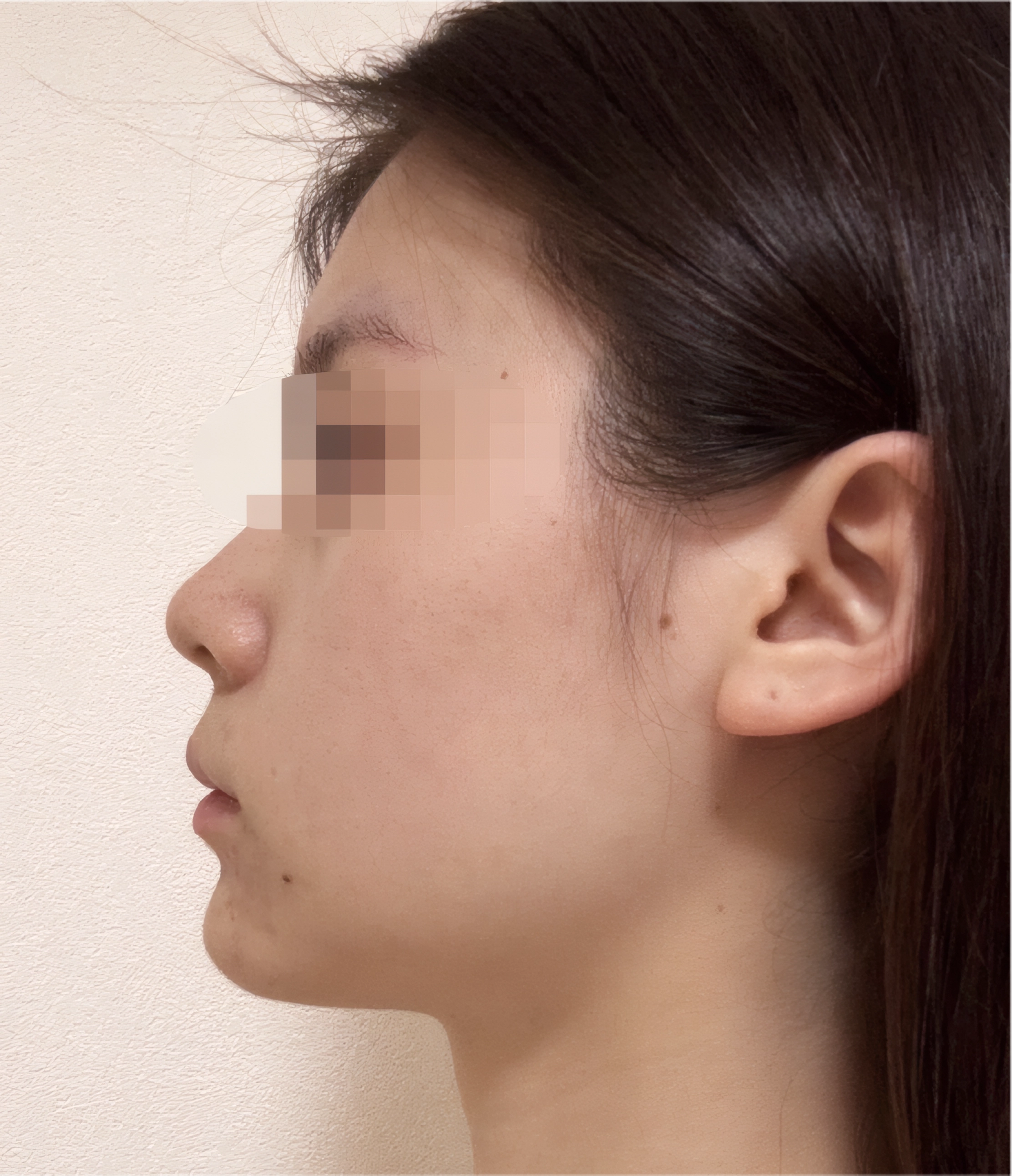 二重顎 AFTER 30代女性