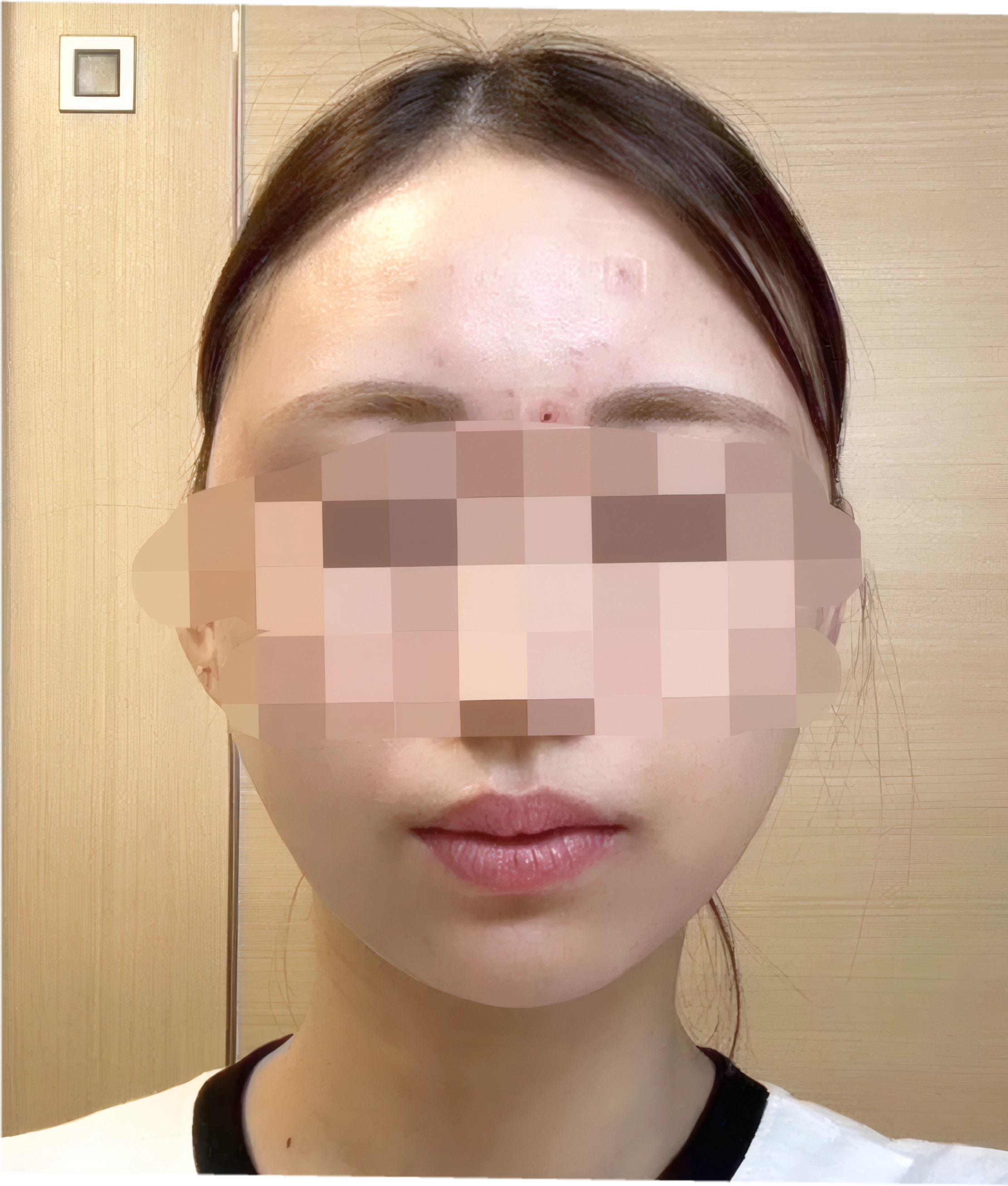 フェイスライン BEFORE 30代女性